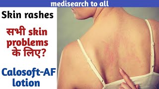 CalosoftAF lotionUsesसभी skin problems के लिएCommon skin rashes How to apply in hindi [upl. by Rezeile]