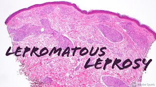 Lepromatous Leprosy 5Minute Pathology Pearls Dermatology Dermatopathology [upl. by Seeto233]