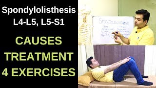 Spondylolisthesis L4L5 L5S1 Spondylolysis Spondylolisthesis Treatment Exercises LOW BACK PAIN [upl. by Aieken]