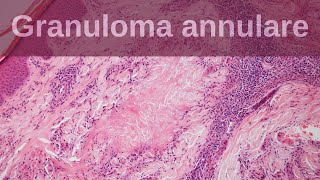 Granuloma Annulare  Pathology mini tutorials [upl. by Adrian]