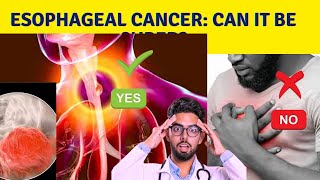 What is the survival rate for esophageal cancer [upl. by Larsen568]