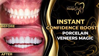 Instant Confidence Boost Porcelain Veneers Magic [upl. by Zoeller710]