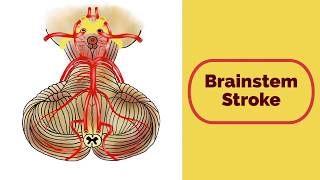 Brainstem Stroke Syndromes [upl. by Jadda]