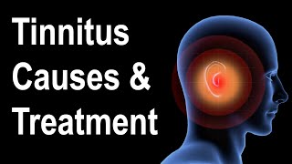 What is Tinnitus Causes amp Treatment Strategies [upl. by Maze]