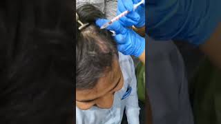 Hair transplant after PRP therapy2024 youtuber hairtreatment song skincare prp explore skin [upl. by Warford203]