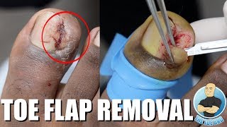 TOE FLAP REMOVAL OF FLESHY INGROWN TOENAIL [upl. by Roth633]