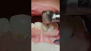 Loose gums and tooth decay repair the dentist Fill the🦷beadrepaircheapsavemoneyfillfixtooth [upl. by Erin]