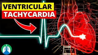 Ventricular Tachycardia Vtach  Medical Explainer Video [upl. by Les822]