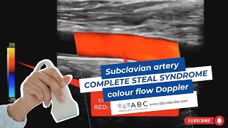 Subclavian artery complete steal syndrome colour flow Doppler Carotid Doppler  Ultrasound [upl. by Abehsat]