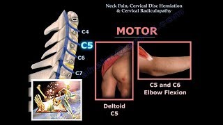 Neck Pain Cervical Disc Herniation amp RadiculopathyEverything You Need To Know  Dr Nabil Ebraheim [upl. by Alekim]