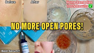 How to get Rid of Large Open Pores Best Home Remedies  Abial openpores [upl. by Nevag]