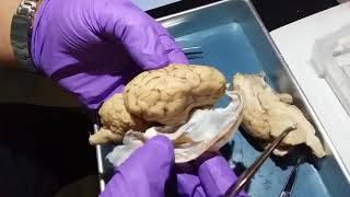 Brain Post Dissection 1 of 2 [upl. by Acherman633]