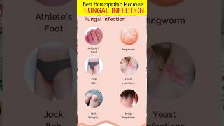 R82 Drops for Fungal Infectiondr reckeweg r82 in hindir82 antifungalmedicine shorts [upl. by Dnomder199]