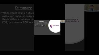 ECG Tip 11 PE ECGs vs Pediatric ones [upl. by Eedyak]