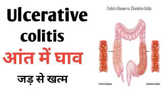 Ulcerative colitis  Traetment and Symptoms  Colistis ko theek kaise kare [upl. by Tanner]