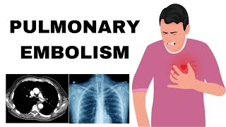 Pulmonary Embolism Pathophysiology Etiology Symptoms Diagnosis amp Treatment [upl. by Lody180]