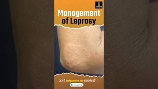 Management of Leprosy  Treatment Prevention Leprosy management treatment shortvideo nursing [upl. by Leo]