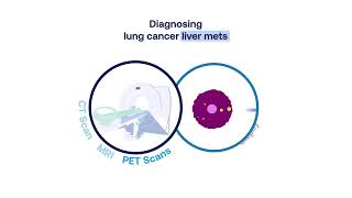 Lung Cancer Liver Metastasis Symptoms Diagnosis and Treatment 2 min [upl. by Lemuela994]