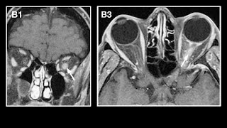 Myelin Oligodendrocyte Glycoprotein Antibodyassociated Disease MOGAD [upl. by Clements549]