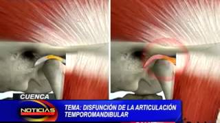 Disfunción en la articulación Temporomandibular Corporación Médica Monte Sinaí [upl. by Aznola]