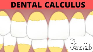 Dental Calculus Part 1 ‖ Dental Calculus Made Easy ‖ Perio Hub ‖ Dr Sneha [upl. by Oizirbaf3]