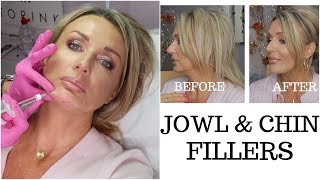 Jowls and Chin Fillers with Before And After Photos  my experience [upl. by Mikihisa]