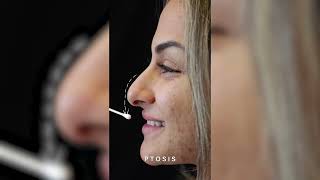 Ethnic Rhinoplasty Before amp After by Dr Ghavami [upl. by Paloma]