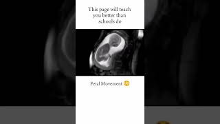 FETAL MOVEMENT😃 short youtubeshorts medical neet [upl. by Kemme]