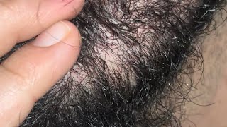 INGROWN HAIRS REMOVED ASMR CATTING BIG PROBLEM REMOVED  INGROWN 10 INGROWN SATISFYING [upl. by Calderon]