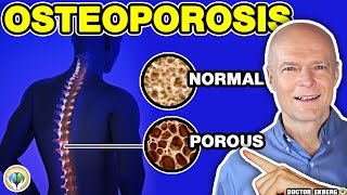 Prevent Osteoporosis Diet Naturally  Dr Ekberg [upl. by Ashman766]