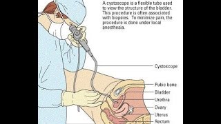 Video Cystoscopy Actual Procedure ENG SUB [upl. by Are]