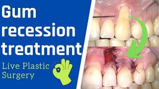 Gum recession surgery  Live Treatment Rotated Pedicle Flap [upl. by Ahtram418]