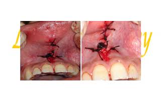 Preprosthetic sugery Soft tissues procedures [upl. by Ettenad]