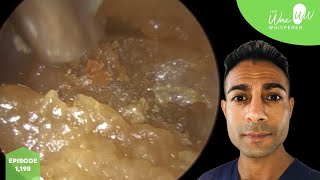 1198  Blocked Ear Wax Removal with Benign Osteoma [upl. by Elenahc210]