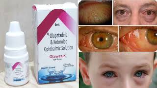 OLOPATADINE and KETROLAC ophthalmic solution  symptoms Treatment  Optometry solution [upl. by Miehar993]