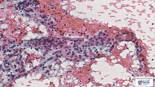 Thyroid cytology Lymphocytic thyroiditis [upl. by Aidiruy]