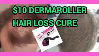 How I Use My Dermaroller for Hair Loss [upl. by Asoramla736]