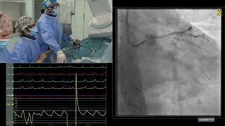 Optimising treatment for patients with severe calcified lesions the role of orbital atherectomy [upl. by Ranzini]