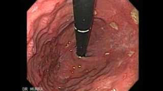 Endoscopy of Multiple Ulcers of the Stomach [upl. by Yecram36]