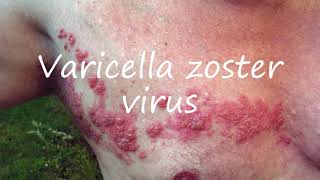 How to Pronounce Varicella zoster virus [upl. by Itsirhc]