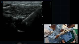 USG guided Shoulder Injection  Ultrasound guided spiration of subcoracoid bursa [upl. by Kean]