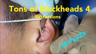 Tons of blackheads 4 Acne extractions Blackheads whiteheads milia Nose ears lips Pore dirt [upl. by Dyl474]