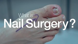 What is Nail Surgery [upl. by Briana595]