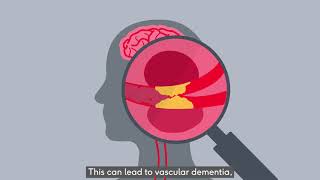 Vascular dementia [upl. by Annahc]