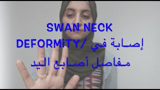 Swan Neck Deformity ،، إصابة مفصل أصابع اليد [upl. by Aurore143]