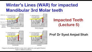 Winters Lines WAR for Impacted Mandibular 3rd Molar  Syed Amjad Shah [upl. by Notfa]