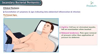 Secondary Bacterial Peritonitis Etiology Clinical features Diagnosis Management Surgery [upl. by Pail]