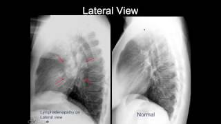 Chest Xray Cases 2 [upl. by Cheyne]