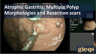 Atrophic Gastritis Multiple Polyp Morphologies and Resection scars [upl. by Eittod602]