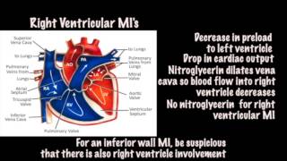 Tintinallis Emergency Medicine 8th edition video  ECG Right Ventricular MI [upl. by Franky]